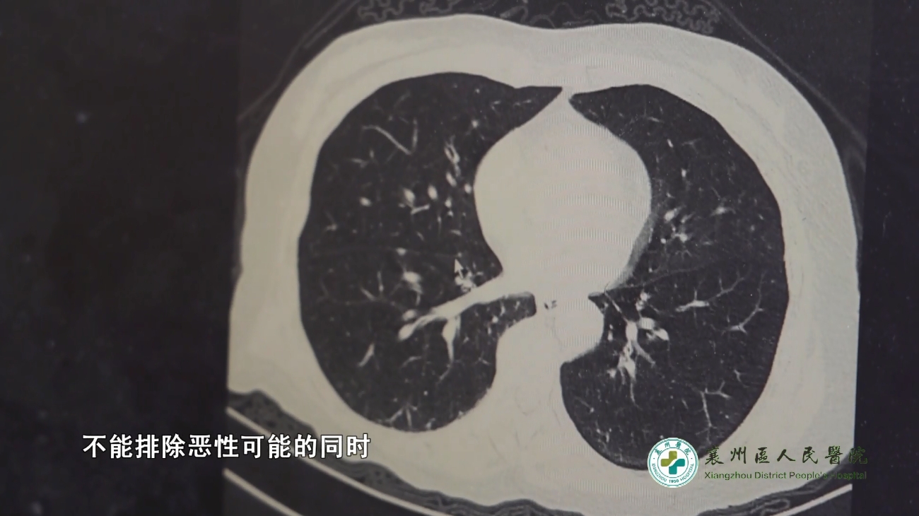 【周末医生】63期——查出肺结节,怎么办? 【周末医生】63期——查出肺结节,怎么办?