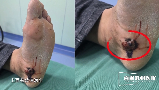 【直通襄州医院⑮】mohs手术精准切除黑色素瘤 【直通襄州医院⑮】mohs手术精准切除黑色素瘤